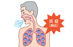 重症化して命にかかわることも　肺炎にご注意！