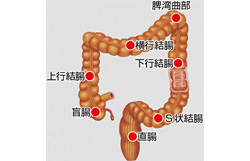突然の腹痛と血の混じった下痢。虚血性大腸炎とは？