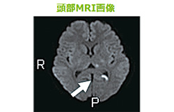 閃輝暗点のあと頭痛がおこらなくなってきた。考えられる原因は？