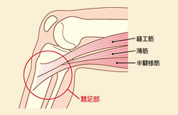 膝の痛みで鵞足炎と診断。抗炎症薬をのんでも痛みが治まらない