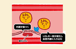 自覚症状がないからこそ今始める！　動脈硬化対策
